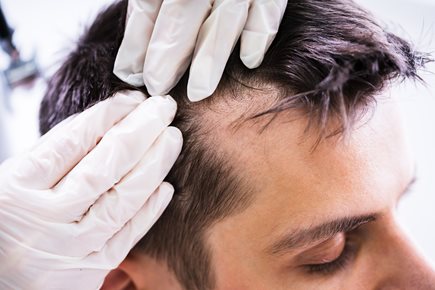 hair loss