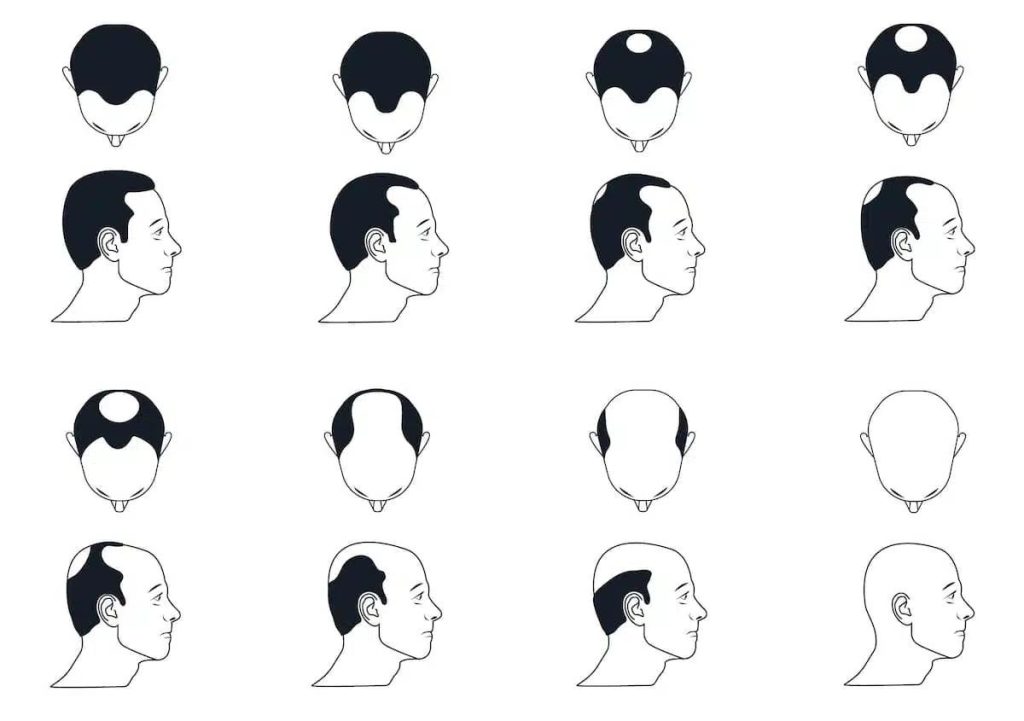 Testosterone and Hair Loss