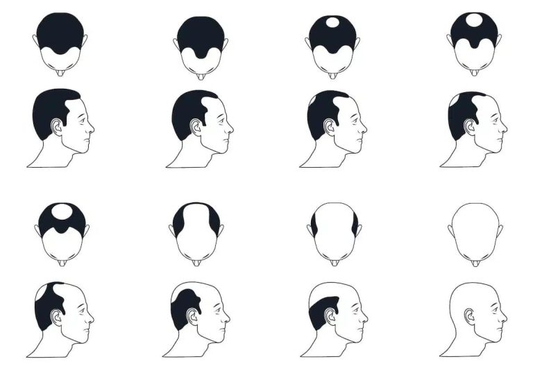 Testosterone and Hair Loss
